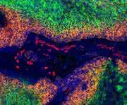 Gebärmutterhalskrebs: In den grün gefärbten Bereichen des Tumors herrscht Sauerstoffmangel. Dort bilden die Krebszellen kein HPV-E7 (orange). Zellkerne sind blau, Blutgefäße rot markiert. (© Dr. Arnulf Mayer, Universität Mainz)