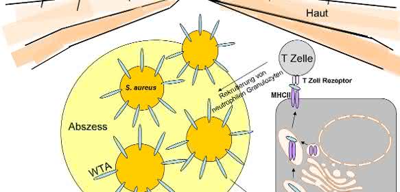 Das Zellhüllen-Zuckerpolymer Wandteichonsäure (WTA) von Staphylococcus aureus spielt bei der Entwicklung von Hautinfektionen eine Rolle. Das Zellhüllen-Zuckerpolymer Wandteichonsäure (WTA) von Staphylococcus aureus spielt bei der Entwicklung von Hautinfektionen eine Rolle.