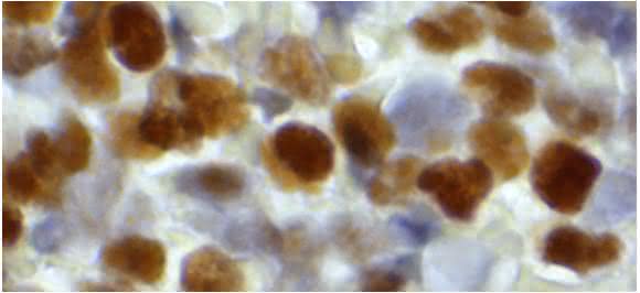 Entartete Vorläuferzellen (AML-Blasten) im Knochenmark eines Patienten mit Akuter Myeolischer Leukämie. Die intensive Braunfärbung zeigt die verhängnisvolle Aktivität des Enzyms SAMDH1 – bei einem schlechten Ansprechen des Patienten auf eine Cytarabin-haltige Therapie. (Aufnahme: Institut für Pathologie, Universitätsmedizin Göttingen) Entartete Vorläuferzellen (AML-Blasten) im Knochenmark eines Patienten mit Akuter Myeolischer Leukämie. Die intensive Braunfärbung zeigt die verhängnisvolle Aktivität des Enzyms SAMDH1 – bei einem schlechten Ansprechen des Patienten auf eine Cytarabin-haltige Therapie. (Aufnahme: Institut für Pathologie, Universitätsmedizin Göttingen)