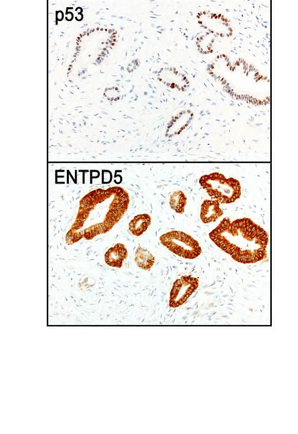 Ausschnitt aus einem Bauchspeicheldrüsen-Tumor: Tumorzellen, die viel p53 bilden (braun gefärbte Zellen im oberen Bild), produzieren auch viel ENTPD5 (braune Färbung im unteren Bild). (Aufnahme: AG Stiewe / Philipps-Universität Marburg) Ausschnitt aus einem Bauchspeicheldrüsen-Tumor: Tumorzellen, die viel p53 bilden (braun gefärbte Zellen im oberen Bild), produzieren auch viel ENTPD5 (braune Färbung im unteren Bild). (Aufnahme: AG Stiewe / Philipps-Universität Marburg)