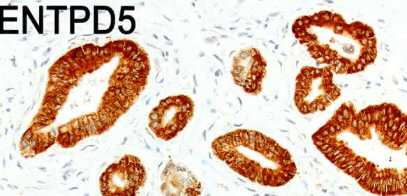 Ausschnitt aus einem Bauchspeicheldrüsen-Tumor: Tumorzellen, die viel p53 bilden (braun gefärbte Zellen im oberen Bild), produzieren auch viel ENTPD5 (braune Färbung im unteren Bild). (Aufnahme: AG Stiewe / Philipps-Universität Marburg)