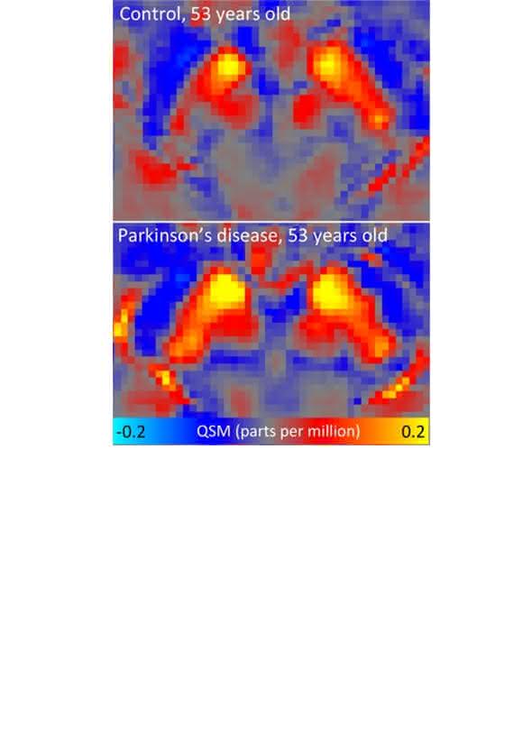 DZNE-Forscher haben in den Gehirnen von Menschen mit Parkinson ungewöhnliche Eisenwerte festgestellt. In einigen Hirnbereichen war der Eisengehalt überhöht, in anderen relativ niedrig. So war beispielsweise in der „Substantia nigra“ - einer wichtigen Hirnregion für die Bewegungskontrolle - die Eisenkonzentration ungewöhnlich hoch. Dies lässt sich an diesen Hirnscans erkennen: Sie zeigen die Substantia nigra bei einem gesunden Studienteilnehmer und einem Parkinson-Betroffenen. Ein starkes QSM-Signal (rot und gelb) weist auf hohe Eisenwerte hin. (Bild: DZNE / Julio Acosta-Cabronero)