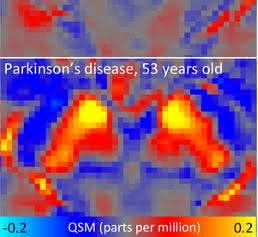 DZNE-Forscher haben in den Gehirnen von Menschen mit Parkinson ungewöhnliche Eisenwerte festgestellt. In einigen Hirnbereichen war der Eisengehalt überhöht, in anderen relativ niedrig. So war beispielsweise in der „Substantia nigra“ - einer wichtigen Hirnregion für die Bewegungskontrolle - die Eisenkonzentration ungewöhnlich hoch. Dies lässt sich an diesen Hirnscans erkennen: Sie zeigen die Substantia nigra bei einem gesunden Studienteilnehmer und einem Parkinson-Betroffenen. Ein starkes QSM-Signal (rot und gelb) weist auf hohe Eisenwerte hin. (Bild: DZNE / Julio Acosta-Cabronero)