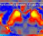 DZNE-Forscher haben in den Gehirnen von Menschen mit Parkinson ungewöhnliche Eisenwerte festgestellt. In einigen Hirnbereichen war der Eisengehalt überhöht, in anderen relativ niedrig. So war beispielsweise in der „Substantia nigra“ - einer wichtigen Hirnregion für die Bewegungskontrolle - die Eisenkonzentration ungewöhnlich hoch. Dies lässt sich an diesen Hirnscans erkennen: Sie zeigen die Substantia nigra bei einem gesunden Studienteilnehmer und einem Parkinson-Betroffenen. Ein starkes QSM-Signal (rot und gelb) weist auf hohe Eisenwerte hin. (Bild: DZNE / Julio Acosta-Cabronero)