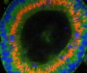 Darmkrebszellen wachsen zu dreidimensionalen Organoiden in der Kulturschale heran. (Quelle: Joseph Regan)