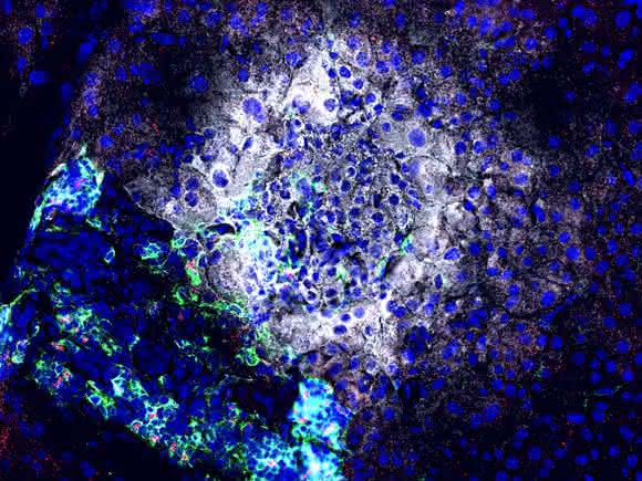 Nach Gabe eines antagomir gegen miR92a werden Insulin (weiß) produzierende Betazellen seltener von Immunzellen (grün) angegriffen. Zudem sind mehr regulatorische T Zellen (rot) vorhanden, die die Betazellen (weiß) schützen können. (Quelle: Helmholtz Zentrum München) Nach Gabe eines antagomir gegen miR92a werden Insulin (weiß) produzierende Betazellen seltener von Immunzellen (grün) angegriffen. Zudem sind mehr regulatorische T Zellen (rot) vorhanden, die die Betazellen (weiß) schützen können. (Quelle: Helmholtz Zentrum München)