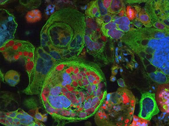 Blick durchs Mikroskop: Das Bild verdeutlicht die Verschiedenartigkeit von Tumorzellen von Glioblastompatienten. Der rote Farbstoff ist ein spezieller Tumorzell-Marker, das Skelett der zum Teil riesigen Tumorzellen ist in grün dargestellt, die Zellkerne in blau. © Aufnahme: Roman Reinartz/Institut für Rekonstruktive Neurobiologie der Uni Bonn