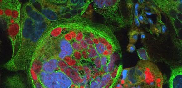 Blick durchs Mikroskop: Das Bild verdeutlicht die Verschiedenartigkeit von Tumorzellen von Glioblastompatienten. Der rote Farbstoff ist ein spezieller Tumorzell-Marker, das Skelett der zum Teil riesigen Tumorzellen ist in grün dargestellt, die Zellkerne in blau. © Aufnahme: Roman Reinartz/Institut für Rekonstruktive Neurobiologie der Uni Bonn Blick durchs Mikroskop: Das Bild verdeutlicht die Verschiedenartigkeit von Tumorzellen von Glioblastompatienten. Der rote Farbstoff ist ein spezieller Tumorzell-Marker, das Skelett der zum Teil riesigen Tumorzellen ist in grün dargestellt, die Zellkerne in blau. © Aufnahme: Roman Reinartz/Institut für Rekonstruktive Neurobiologie der Uni Bonn