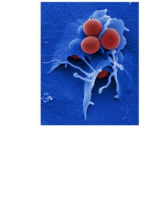 Das Bakterium Staphylococcus aureus (rot) bildet häufig Resistenzen gegen Antibiotika aus. Methicillinresistente Staphylococcus aureus-Stämme (MRSA) sind besonders für Patienten gefährlich, die bereits unter einer Infektion mit dem AIDS-Erreger HIV leiden. (© HZI / M. Rohde) Das Bakterium Staphylococcus aureus (rot) bildet häufig Resistenzen gegen Antibiotika aus. Methicillinresistente Staphylococcus aureus-Stämme (MRSA) sind besonders für Patienten gefährlich, die bereits unter einer Infektion mit dem AIDS-Erreger HIV leiden. (© HZI / M. Rohde)