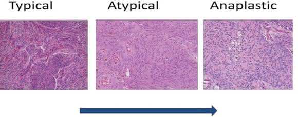 istopathological progression