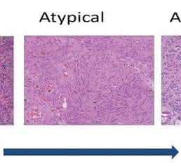 istopathological progression