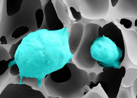 Prostatakrebszellen (grün) in einem hochporösen Cryogel mit gewebeähnlicher Elastizität. (Rasterelektronenmikroskop-Aufnahme: Bettina Göppert / KIT)