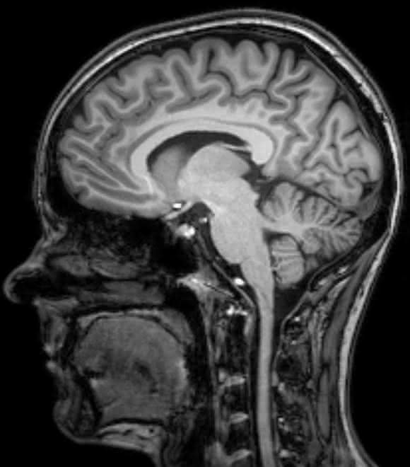 Magnetresonanztomographische Aufnahme eines Schädels (Hirnscan). (Foto/Copyright: Klinik für Radiologie und Neuroradiologie, UKSH, Campus Kiel) Magnetresonanztomographische Aufnahme eines Schädels (Hirnscan). (Foto/Copyright: Klinik für Radiologie und Neuroradiologie, UKSH, Campus Kiel)