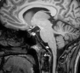 Magnetresonanztomographische Aufnahme eines Schädels (Hirnscan). (Foto/Copyright: Klinik für Radiologie und Neuroradiologie, UKSH, Campus Kiel) Magnetresonanztomographische Aufnahme eines Schädels (Hirnscan). (Foto/Copyright: Klinik für Radiologie und Neuroradiologie, UKSH, Campus Kiel)