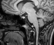 Magnetresonanztomographische Aufnahme eines Schädels (Hirnscan). (Foto/Copyright: Klinik für Radiologie und Neuroradiologie, UKSH, Campus Kiel)
