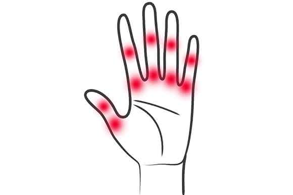 Rheumatoide Arthritis führt zu starken chronischen Gelenkentzündungen. FAU-Wissenschaftler haben nun einen Mechanismus entdeckt, mit dem sich die Entzündungen hemmen lassen. (Bild: Medizinische Klinik 3 der FAU) Rheumatoide Arthritis führt zu starken chronischen Gelenkentzündungen. FAU-Wissenschaftler haben nun einen Mechanismus entdeckt, mit dem sich die Entzündungen hemmen lassen. (Bild: Medizinische Klinik 3 der FAU)