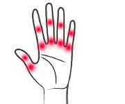 Rheumatoide Arthritis führt zu starken chronischen Gelenkentzündungen. FAU-Wissenschaftler haben nun einen Mechanismus entdeckt, mit dem sich die Entzündungen hemmen lassen. (Bild: Medizinische Klinik 3 der FAU)