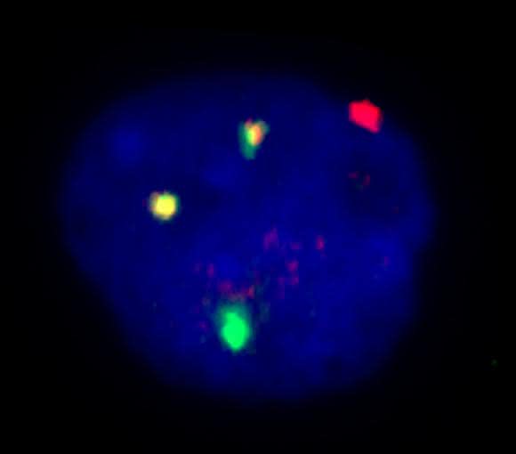 Leukämiezelle mit dem Chromosomenfehler 8;21: Die beiden gelben Signale zeigen, wo sich jeweils ein Stück eines Chromosoms 8 (rot) mit einem Stück von Chromosom 21 (grün) verbunden hat. (Quelle: Stephanie Schneider / Labor für Leukämiediagnostik, Klinikum der LMU)