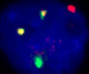 Leukämiezelle mit dem Chromosomenfehler 8;21: Die beiden gelben Signale zeigen, wo sich jeweils ein Stück eines Chromosoms 8 (rot) mit einem Stück von Chromosom 21 (grün) verbunden hat. (Quelle: Stephanie Schneider / Labor für Leukämiediagnostik, Klinikum der LMU)