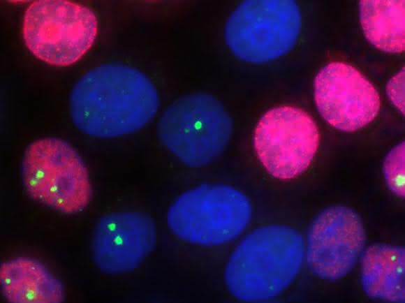 Das Forscherteam benutzte für seine Studie einen zellulären Ansatz, in welchem die Zellkerne (blau) von Tumorzellen mittels Immunofluoreszenz-Mikroskopie in ihren jeweiligen Zellzyklusphasen erkennbar sind. Replikative Zellen (rot) lassen sich hier von post-replikativen Zellen unterscheiden. In den Zellkernen wurde zusätzlich ein Protein (grün) angefärbt, das unreparierte DNA-Doppelstrangbrüche markiert. (Bild: Julian Spies / TU Darmstadt)
