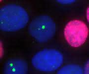 Das Forscherteam benutzte für seine Studie einen zellulären Ansatz, in welchem die Zellkerne (blau) von Tumorzellen mittels Immunofluoreszenz-Mikroskopie in ihren jeweiligen Zellzyklusphasen erkennbar sind. Replikative Zellen (rot) lassen sich hier von post-replikativen Zellen unterscheiden. In den Zellkernen wurde zusätzlich ein Protein (grün) angefärbt, das unreparierte DNA-Doppelstrangbrüche markiert. (Bild: Julian Spies / TU Darmstadt)
