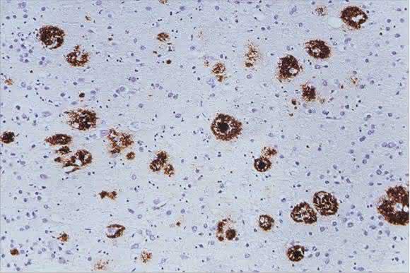 Aβ-Plaques in der Hirnrinde Aβ-Plaques in der Hirnrinde