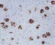 Aβ-Plaques in der Hirnrinde