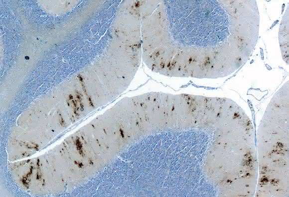 Prion-Ablagerungen im Kleinhirn Prion-Ablagerungen im Kleinhirn