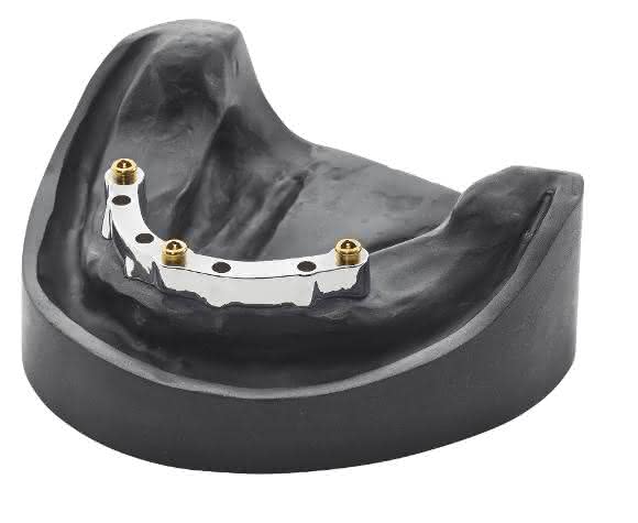 Stege zur Implantatversorgung aus Cobalt Chrom