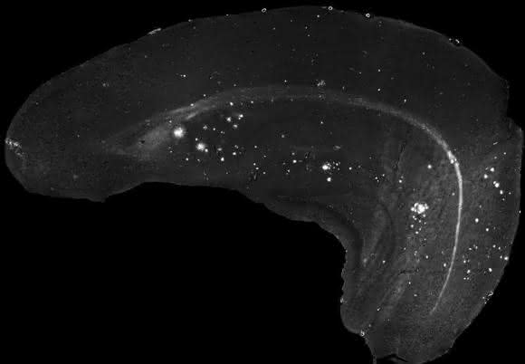 Amyloid-Beta-Proteins im Gehirn