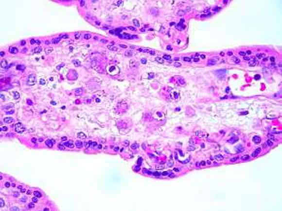 Cytomegalovirus