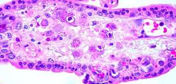 Cytomegalovirus