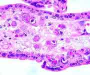 Cytomegalovirus