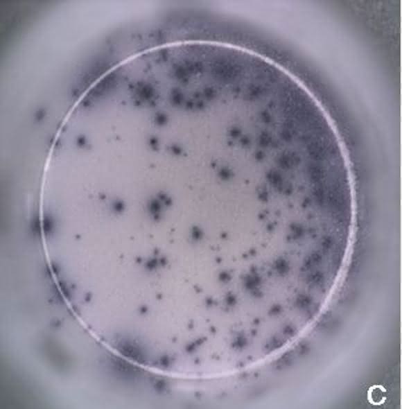Sensitive und spezifische Diagnose im Frühstadium: Lyme Borreliose
