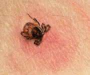 Sensitive und spezifische Diagnose im Frühstadium: Lyme Borreliose