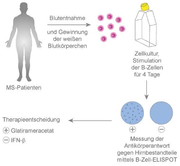 Ein an der Uni Würzburg entwickelter Bluttest kann die Therapie-Entscheidung bei Multipler Sklerose erleichtern. (Grafik: Michael Christof) Ein an der Uni Würzburg entwickelter Bluttest kann die Therapie-Entscheidung bei Multipler Sklerose erleichtern. (Grafik: Michael Christof)