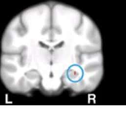 Hippocampus: Hippocampus: Wissenschaftler der Universität Basel haben nachgewiesen, dass Gedächtnisfunktionen von Calcium-Genen abhängen
