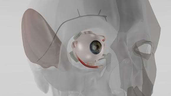 Auge mit Implantat