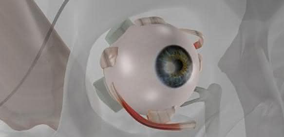 Auge mit Implantat