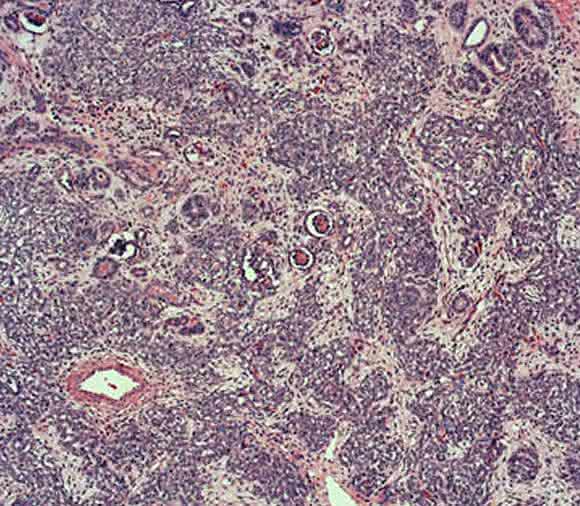 Wilms-Tumor