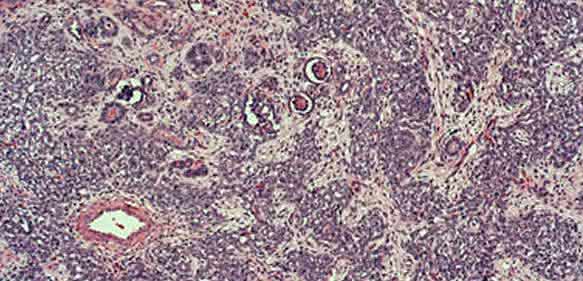 Wilms-Tumor Wilms-Tumor