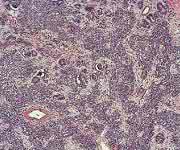 Wilms-Tumor