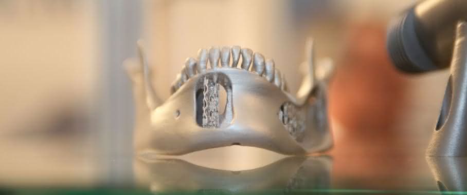 Prothese aus dem 3D-Drucker Prothese aus dem 3D-Drucker