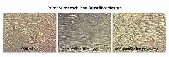Onkologie: Neues Analyseverfahren könnte Brustkrebstherapie revolutionieren