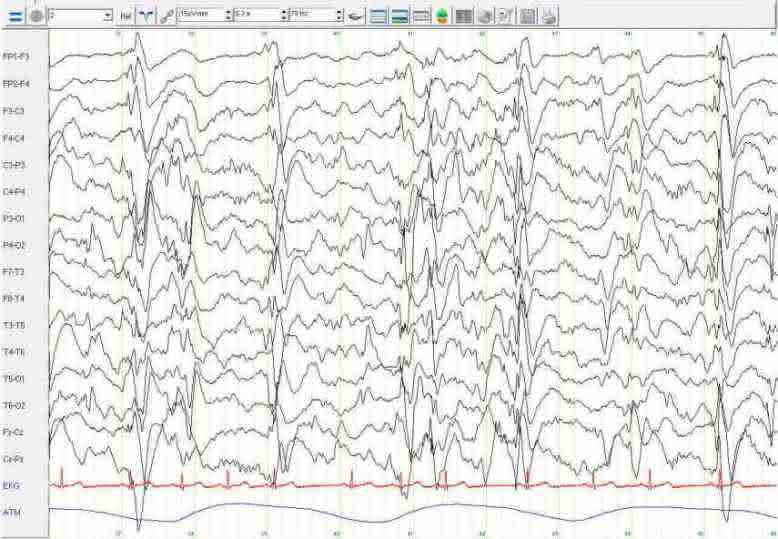 Elektroenzephalogramm (EEG) eines Patienten des Kieler Epilepsie Zentrums