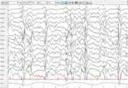 Elektroenzephalogramm (EEG) eines Patienten des Kieler Epilepsie Zentrums