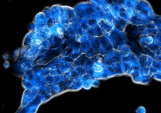 Krebstherapie: Strategie zur Reduktion von Nebenwirkungen