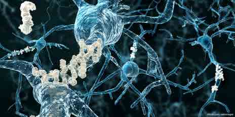 Entstehung neurodegenerativer Krankheiten: an Nervenzellen lagern sich Amyloidplaques ab