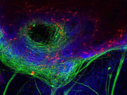 Hirnforscher aus Tübingen und Münster korrigieren DNA-Mutation an humanen Stammzellen: Parkinson im Reagenzglas