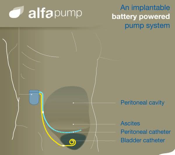 Effiziente Antriebe für Aszites-Implantat: Pumpwerk im Bauchraum
